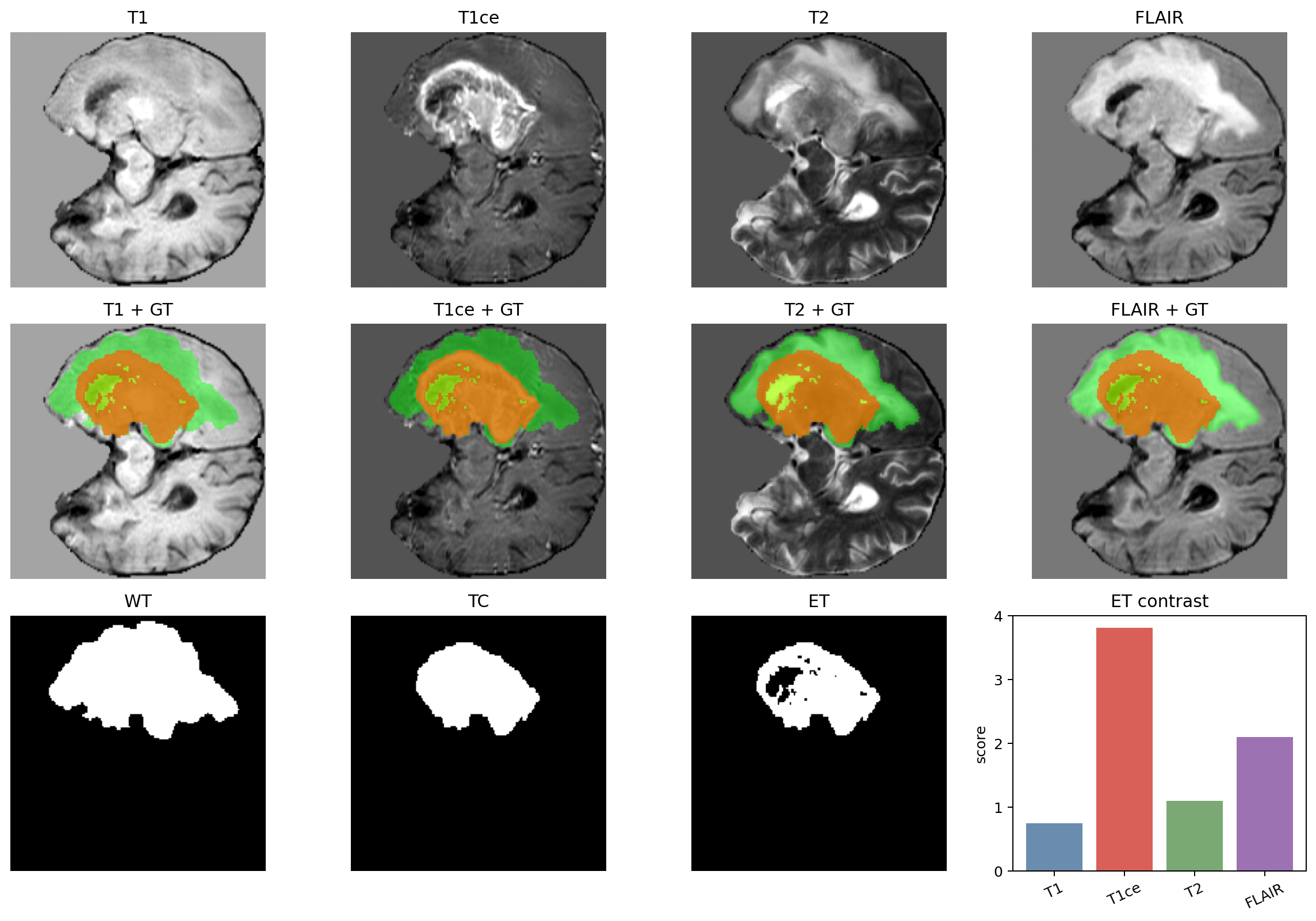 Multi-modal MRI visualization with T1, T1ce, T2, FLAIR, and WT, TC, ET tumor masks.
